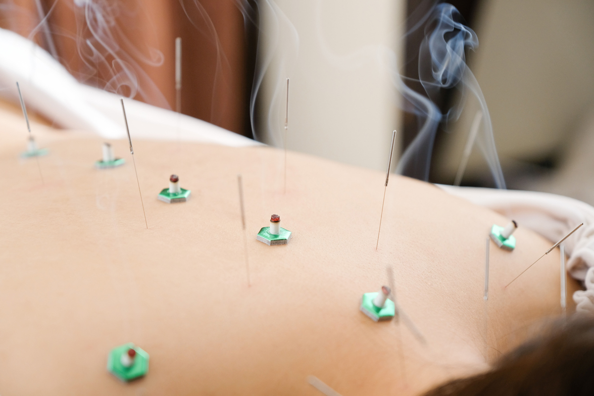 How Long Does Acupuncture Last